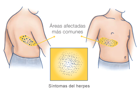 areas mas afectadas por el herpes