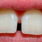 porque se separan los dientes