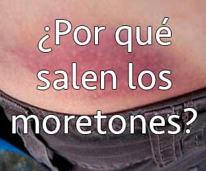 porque salen los moretones